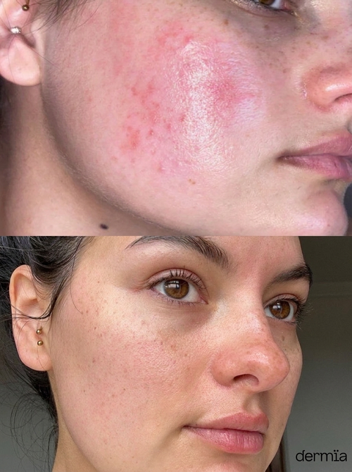 Crème Peau Lisse — Anti-Boutons & Rugosité